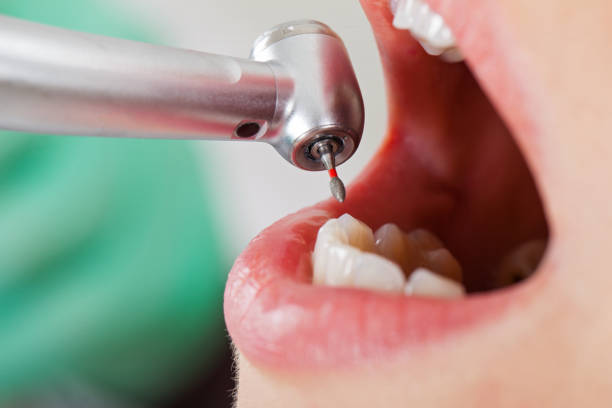 Best Emergency Treatment for Dental Infections or Abscesses in Orwigsburg, PA